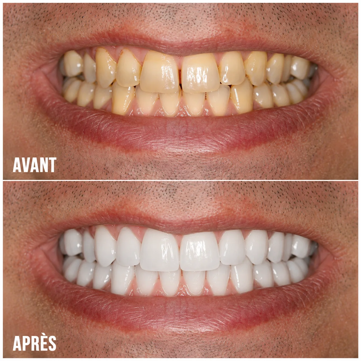 Dentition avant et après un nettoyage dentaire professionnel
